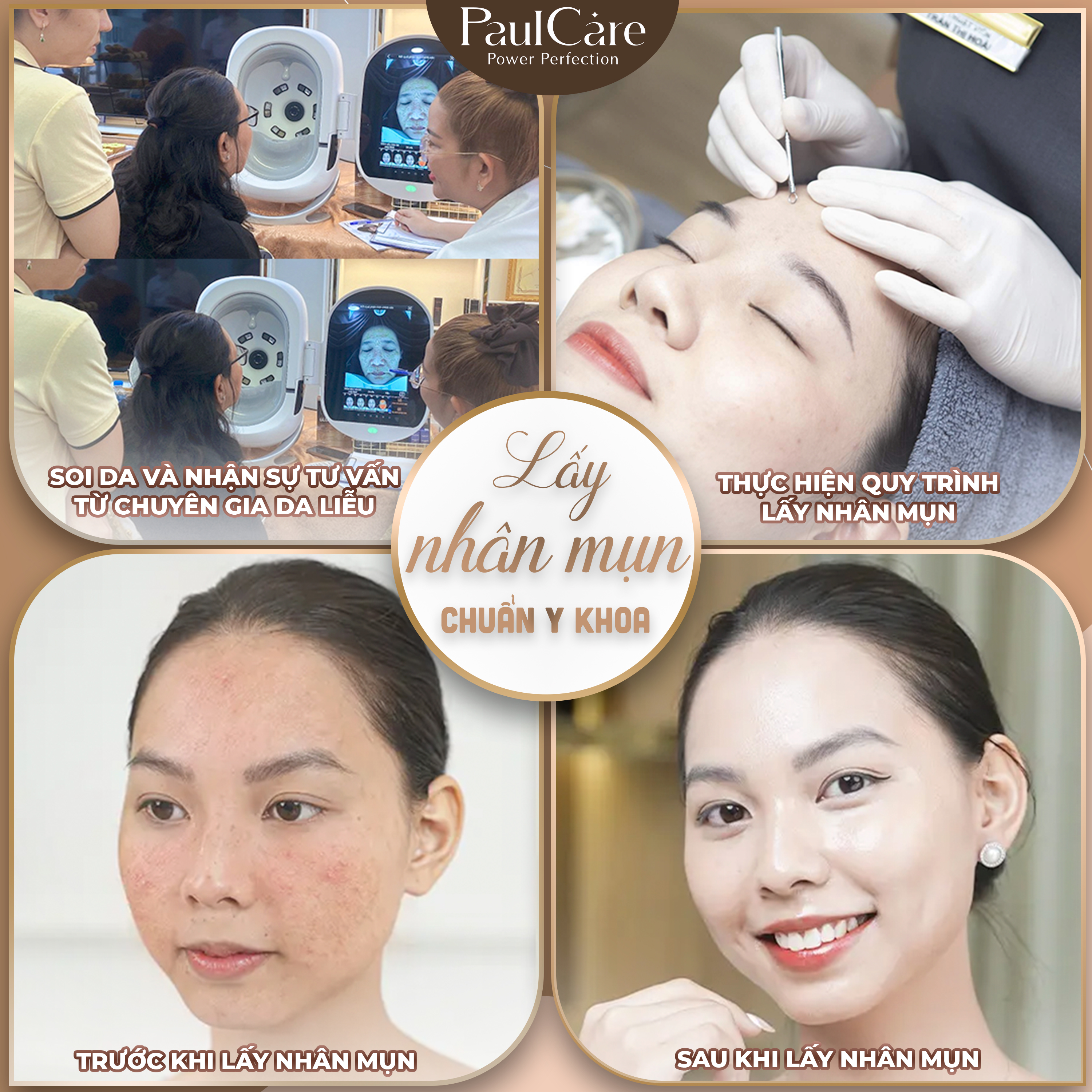 Quy_trinh_lay_nhan_mun_chuan_y_khoa_PaulCare