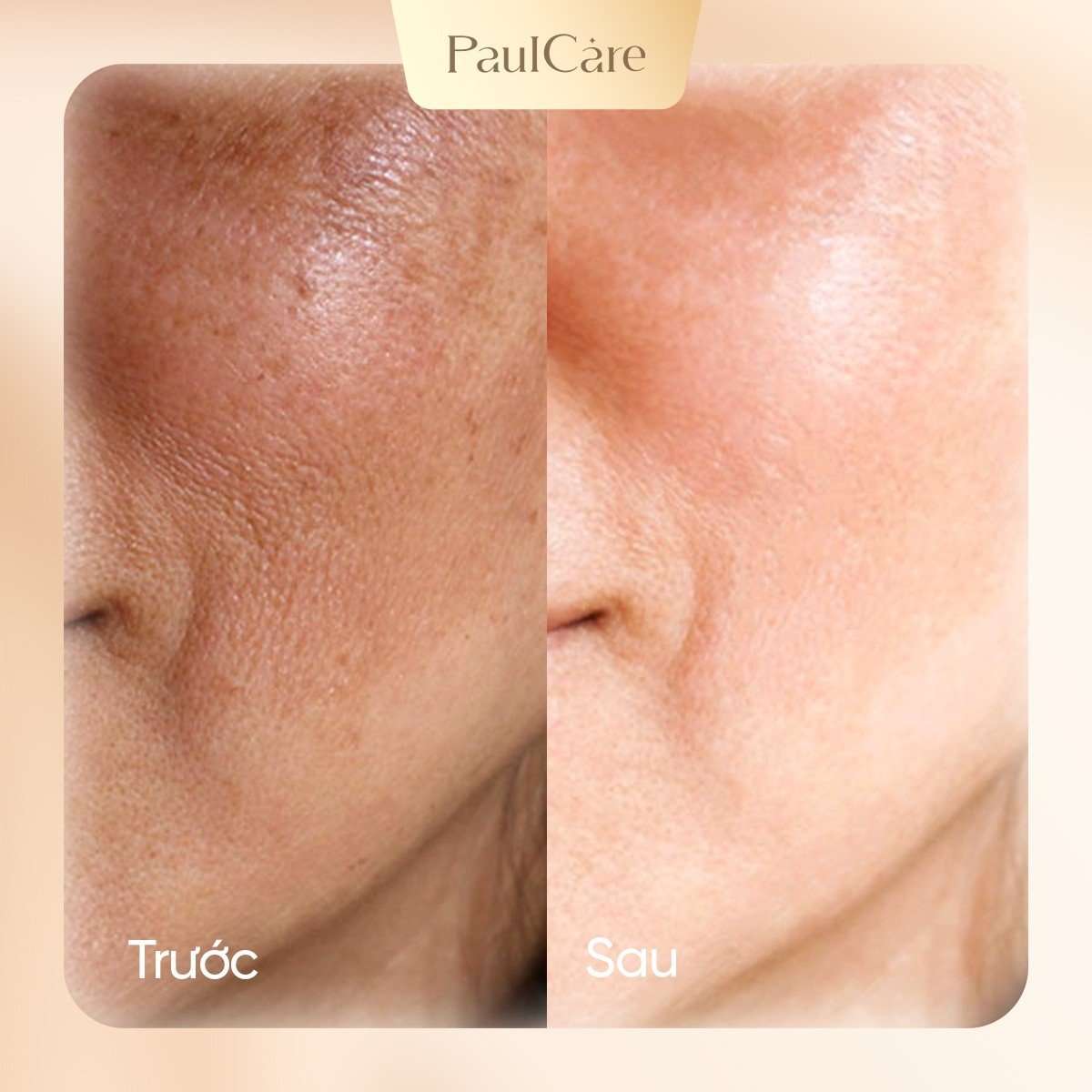 truoc_va_sau_dieu_tri_nam_paulcare_04