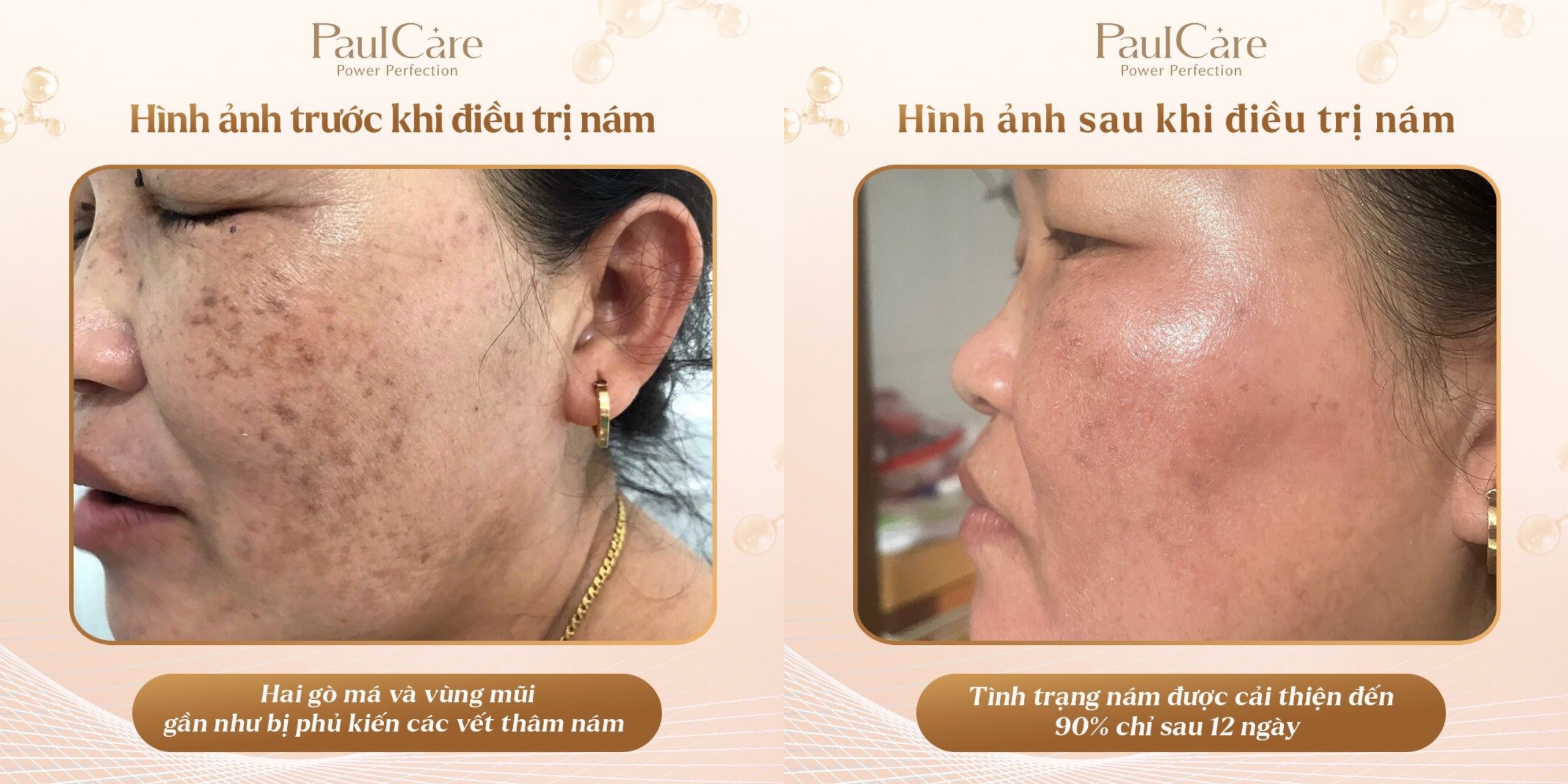 truoc_va_sau_dieu_tri_nam_paulcare_co_tri_4